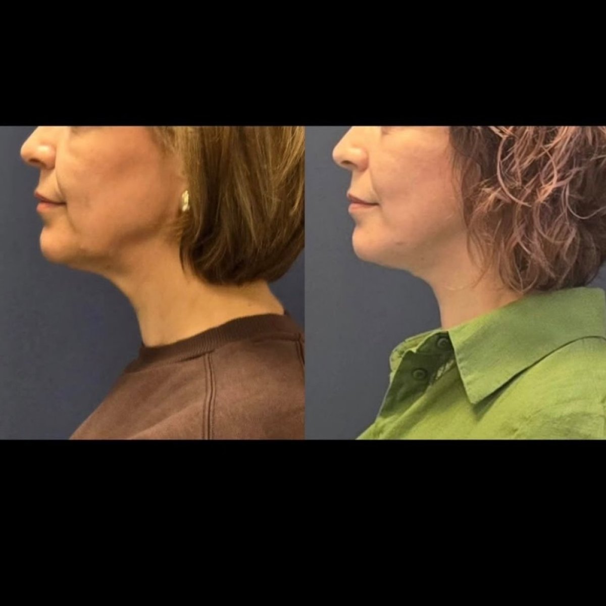 Résultats avant/après liposuccion du cou chez Turan Turan Health Group, contour amélioré