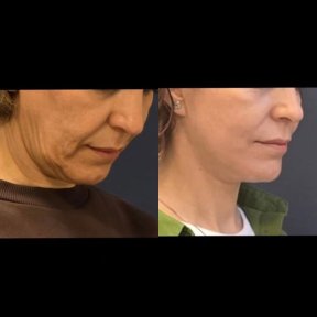 Neck Liposuction - Submental Liposuction (Double Chin Liposuction) - photo 4
