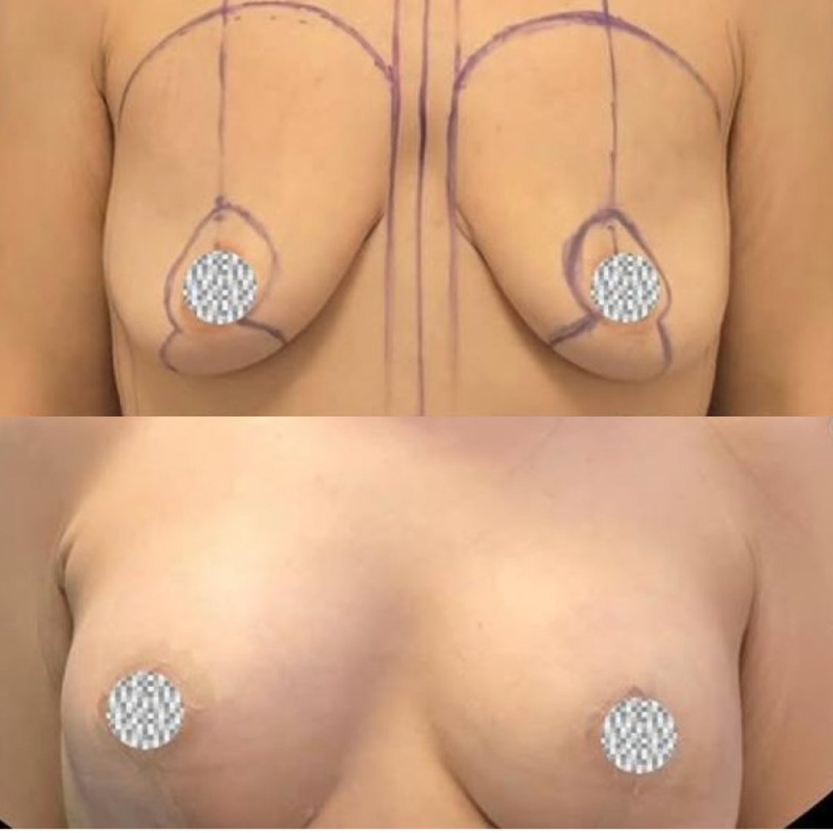 Before and after mammoplasty results at Turan Turan Health Group, breast lift and contouring