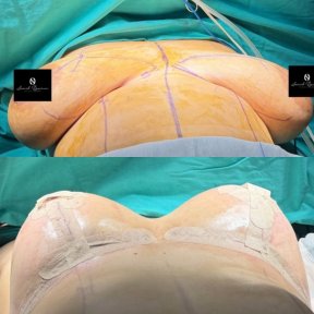 Breast Lift Surgery (Mastopexy) - photo 6