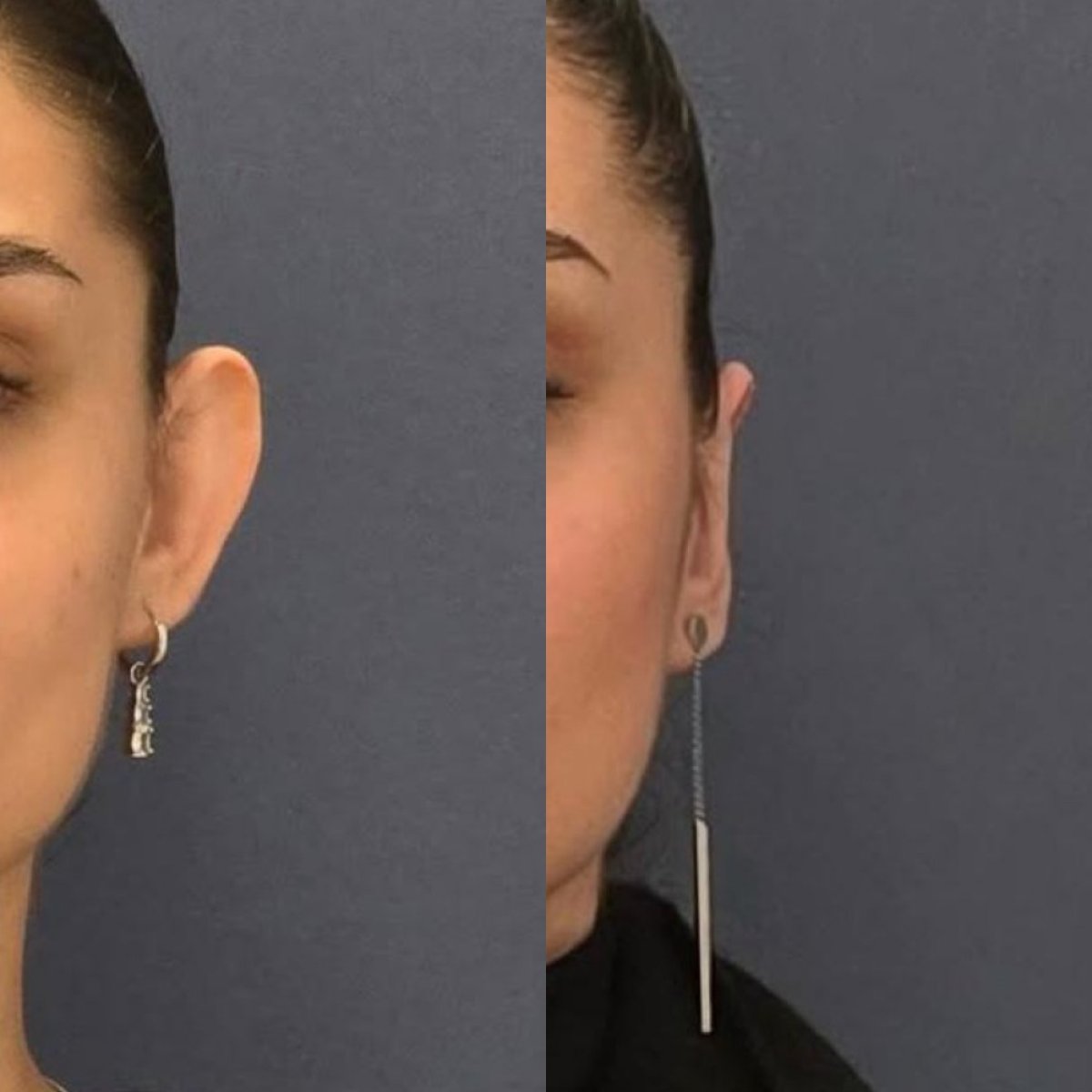Before and after otoplasty results at Turan Turan Health Group, ear reshaping procedure
