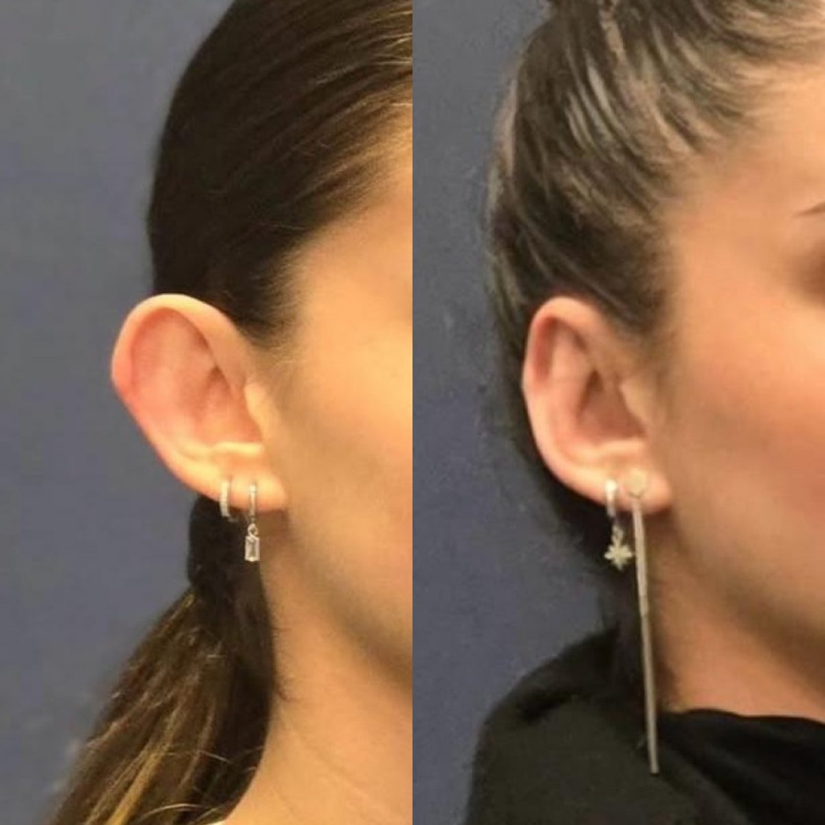 Otoplasty before and after results at Turan Turan Health Group, ear reshaping improvement