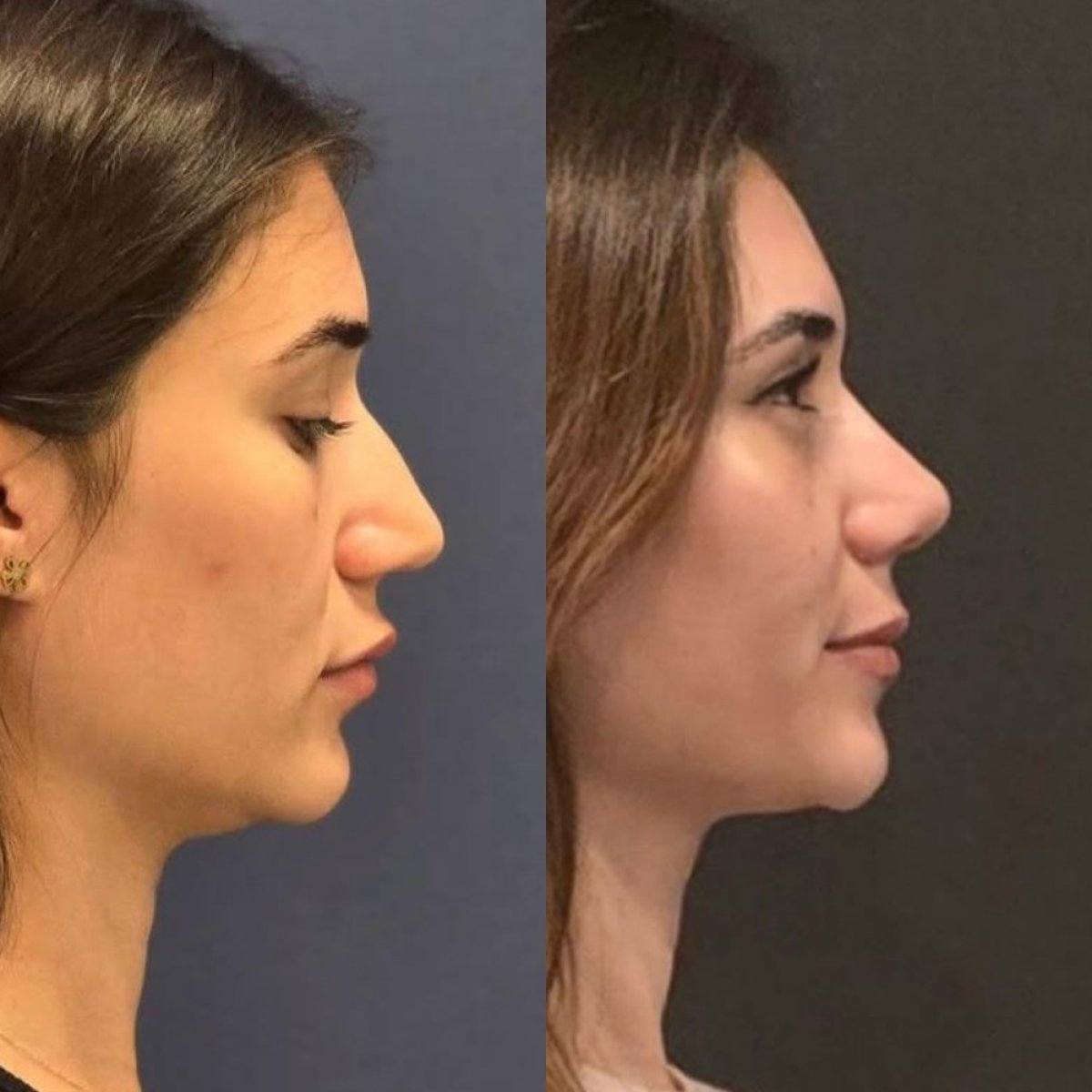 Before and after rhinoplasty results at Turan Turan Health Group, improved nose profile