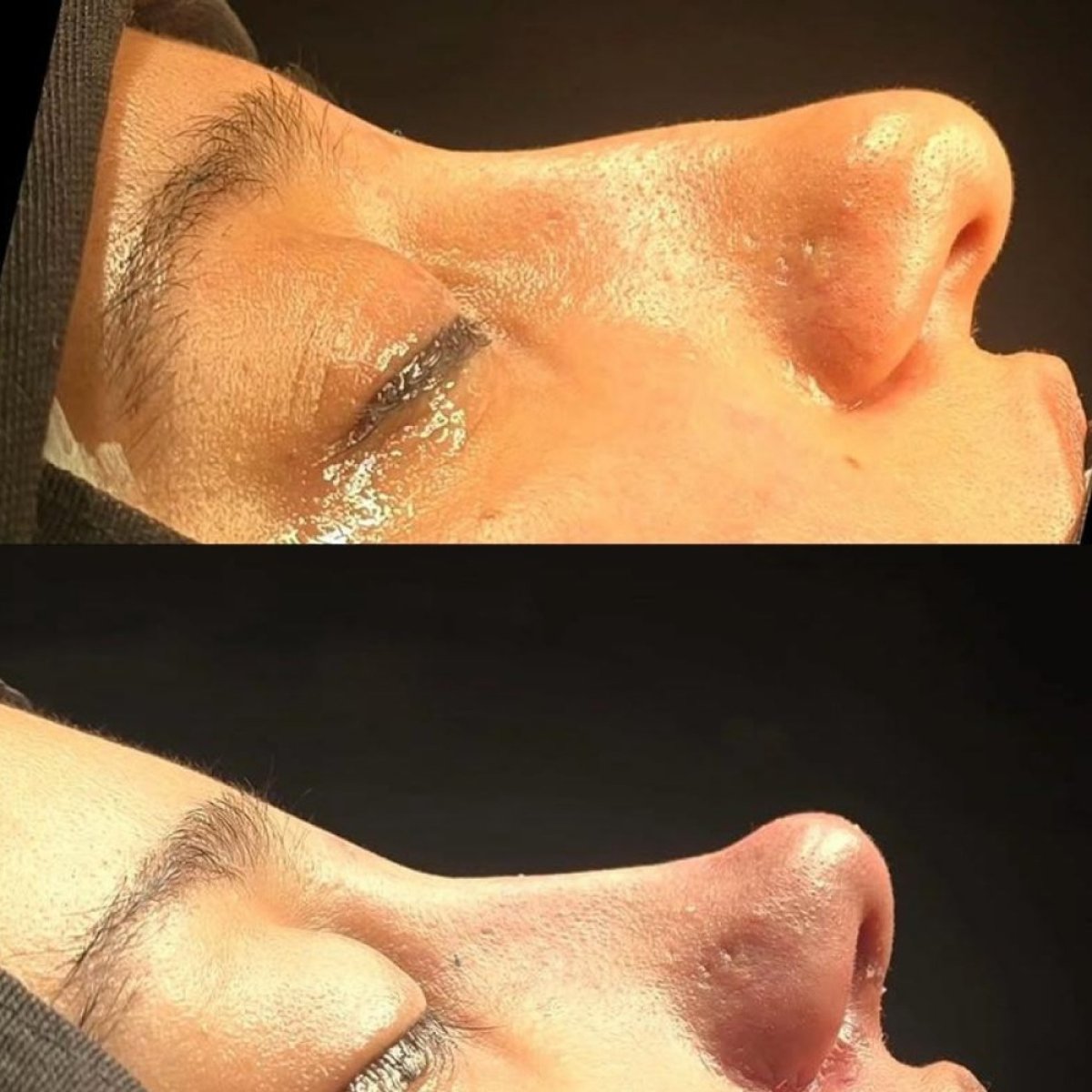 Before and after rhinoplasty results at Turan Turan Health Group, improved nose profile