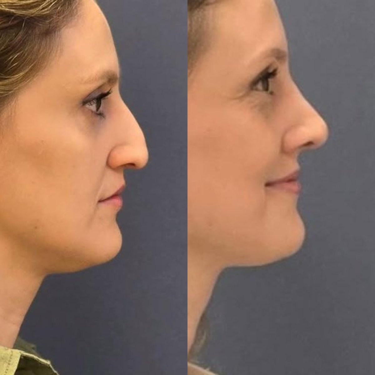 Resultados de rinoplastia antes y después en Turan Turan Health Group, remodelación nasal