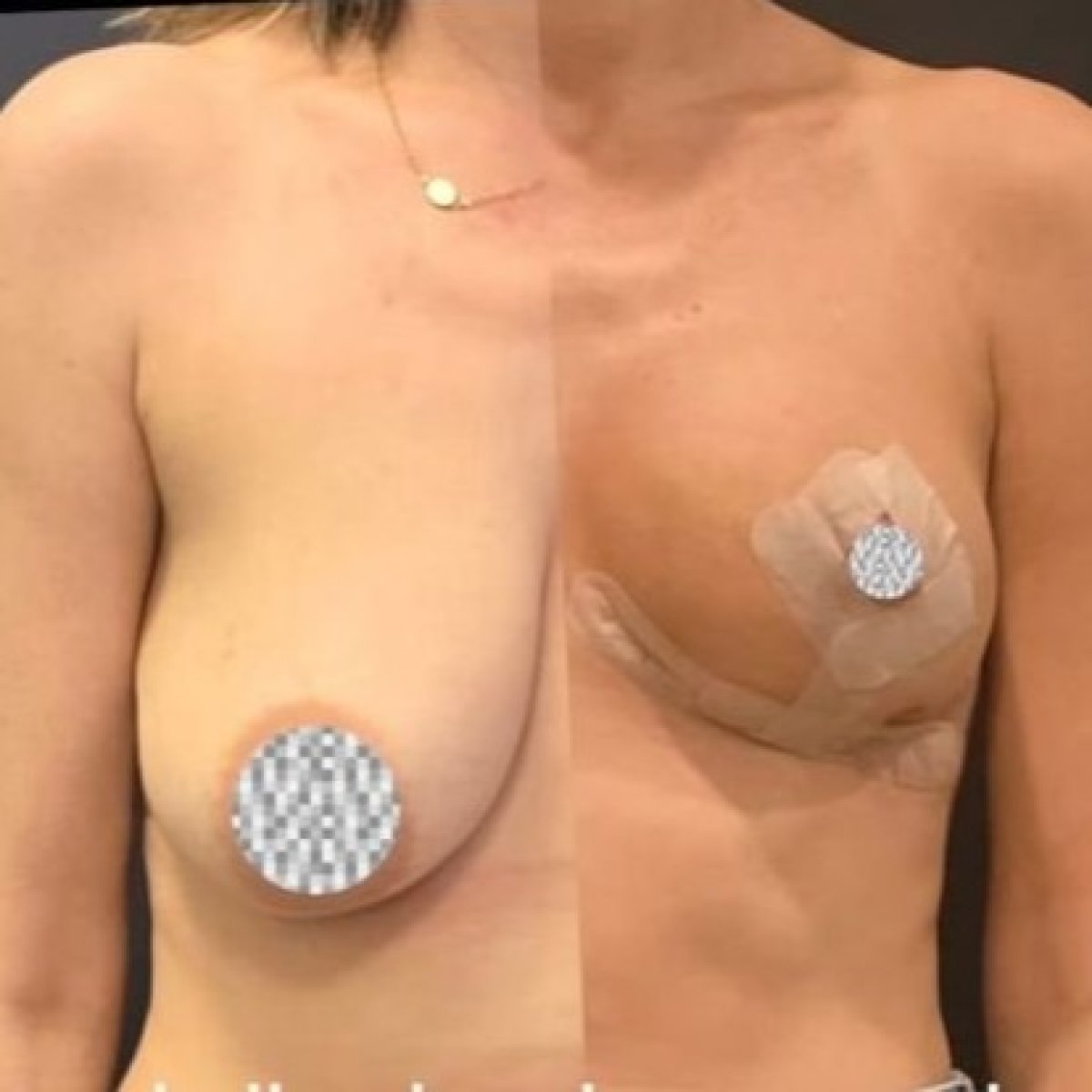Before and after breast lift results at Turan Turan Health Group, improved breast contour