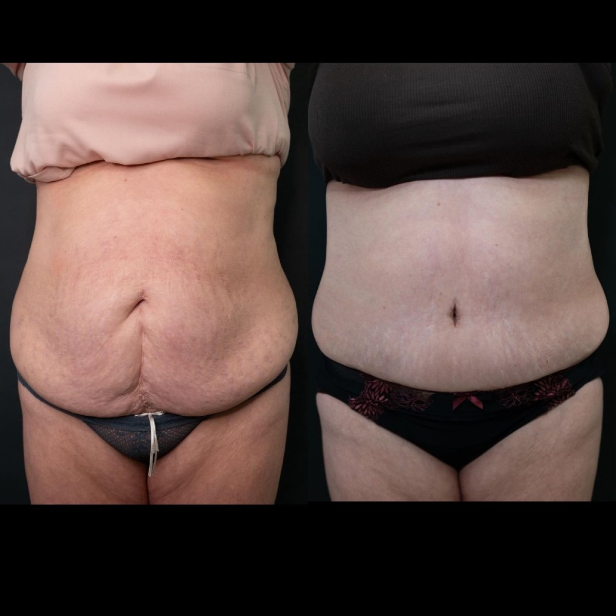 Resultados de abdominoplastia antes y después en Klinika Saska Med, contorno mejorado
