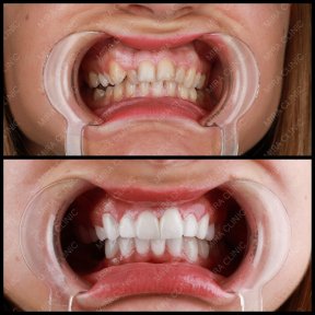 Premium Hollywood smile Procedure - photo 5