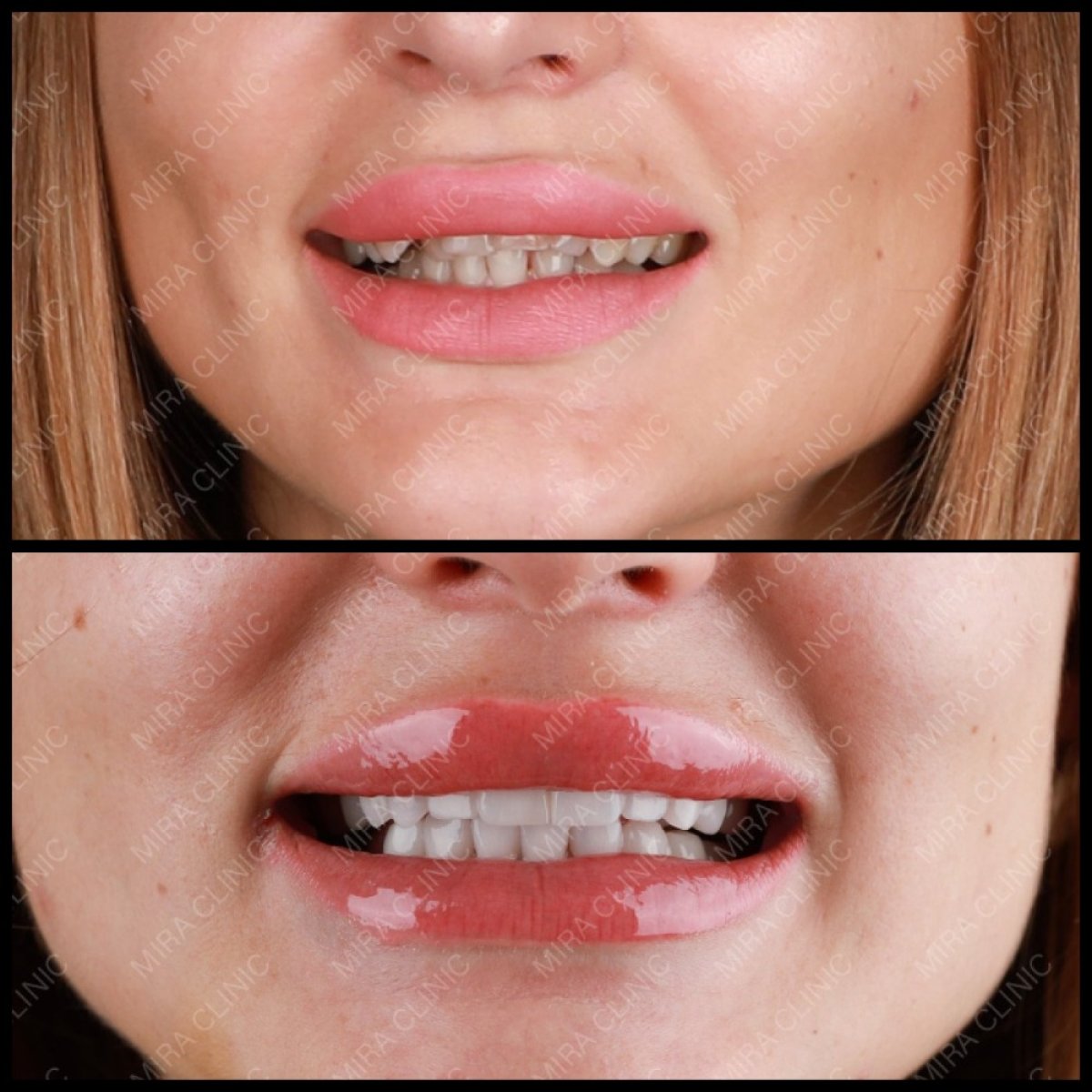 Resultados de antes y después de Hollywood Smile en Mira Clinic, carillas dentales para dientes más blancos