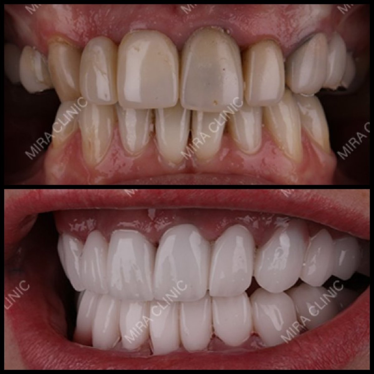Hollywood Smile before and after results at Mira Clinic, dental veneers for whiter teeth