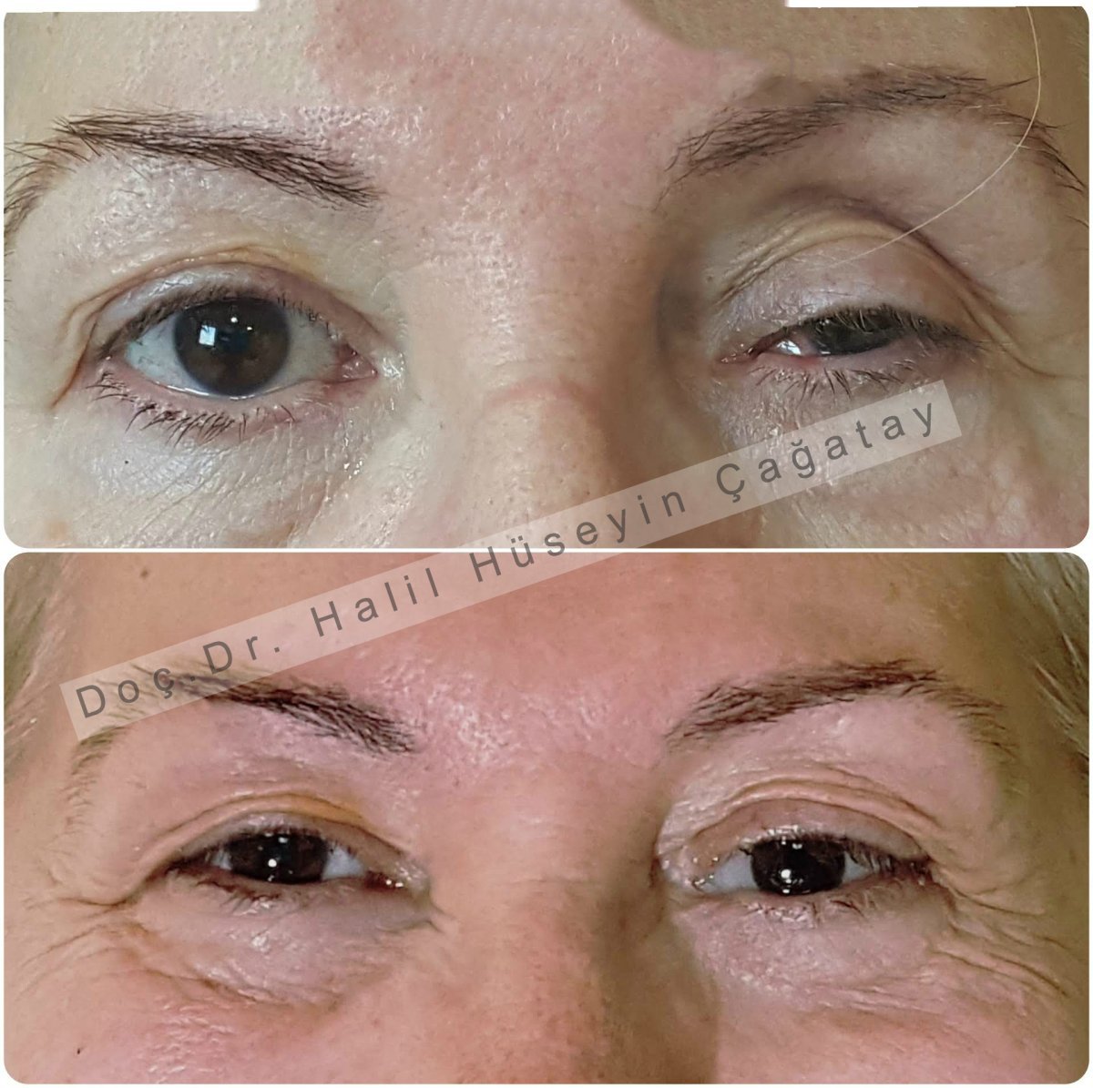 Before and after ptosis surgery results at DrCagatay Eye Clinic, improved eyelid symmetry