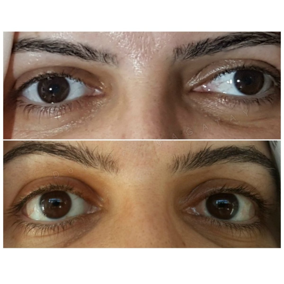Результати до і після операції на косоокість у DrCagatay Eye Clinic, покращене вирівнювання очей
