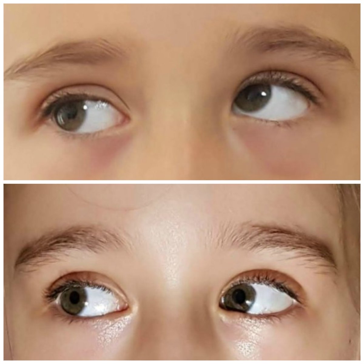 نتائج قبل وبعد جراحة الحول في عيادة DrCagatay Eye Clinic، تحسين محاذاة العينين