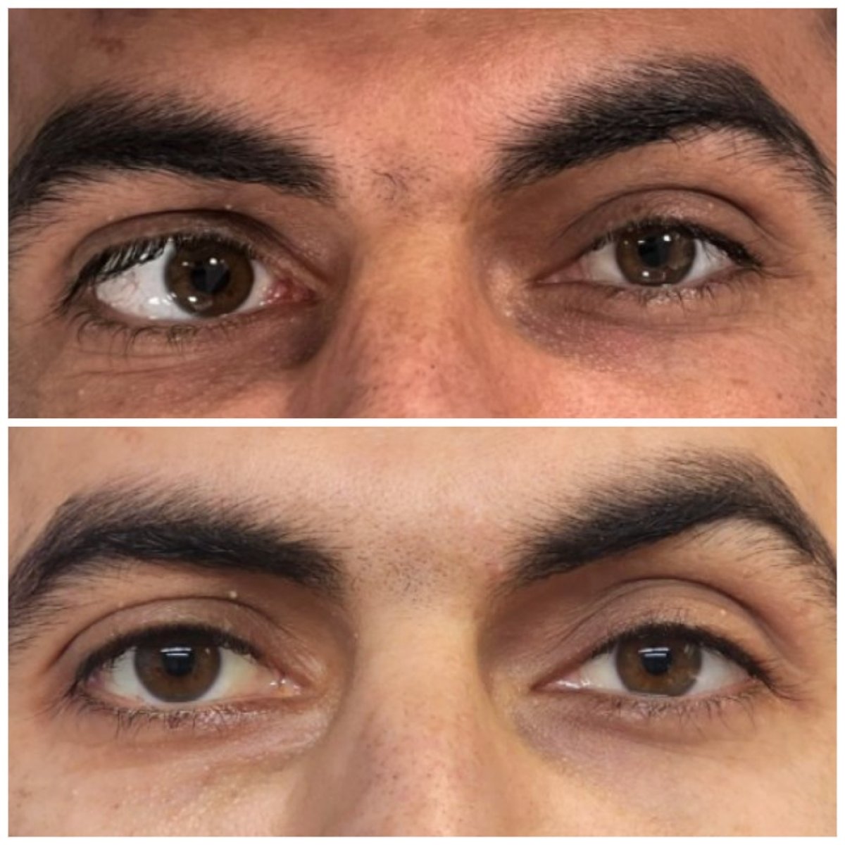 Before and after strabismus surgery result at DrCagatay Eye Clinic, improved eye alignment