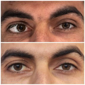 Standard Adult & Pediatric Strabismus Surgery Package - photo 6