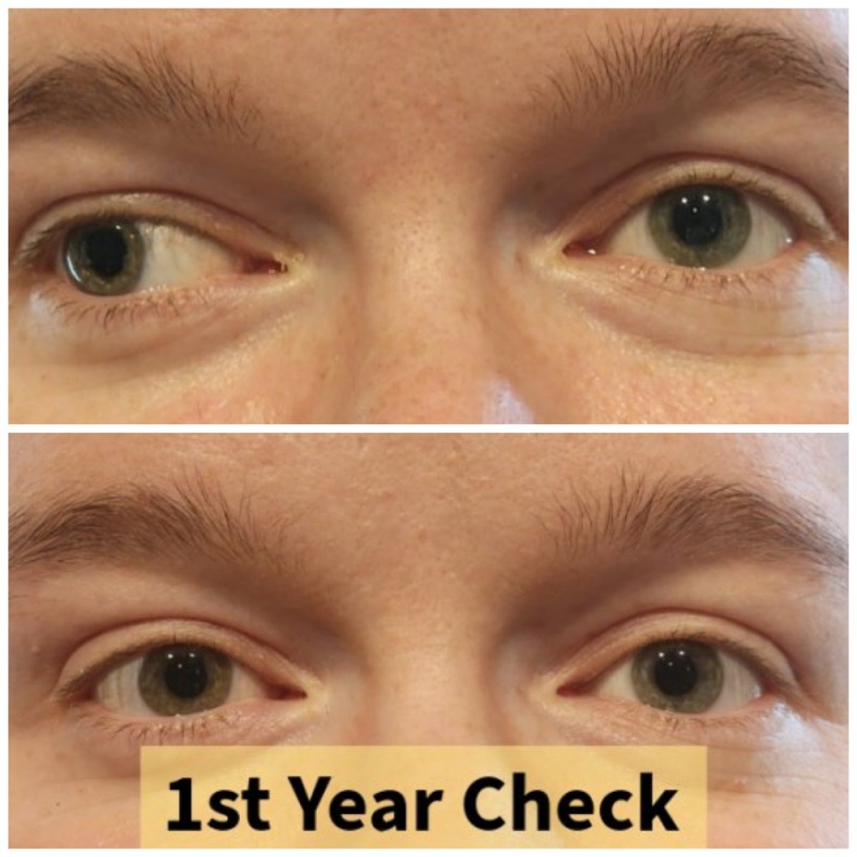 Результати до і після операції косоокості в DrCagatay Eye Clinic, 1 рік після процедури