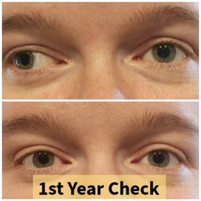 Standard Adult & Pediatric Strabismus Surgery Package - photo 4