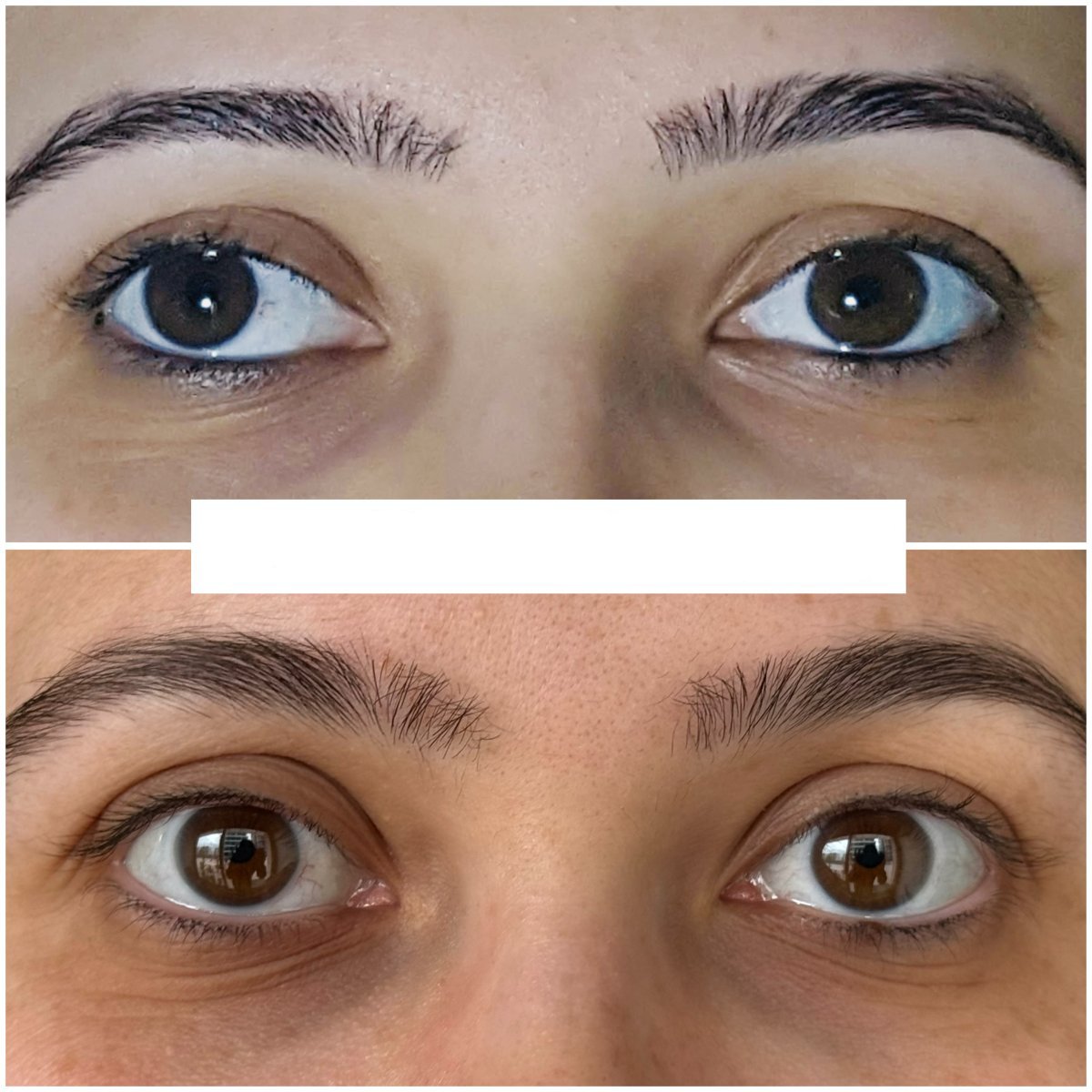 Résultat avant et après chirurgie du strabisme à DrCagatay Eye Clinic, alignement amélioré
