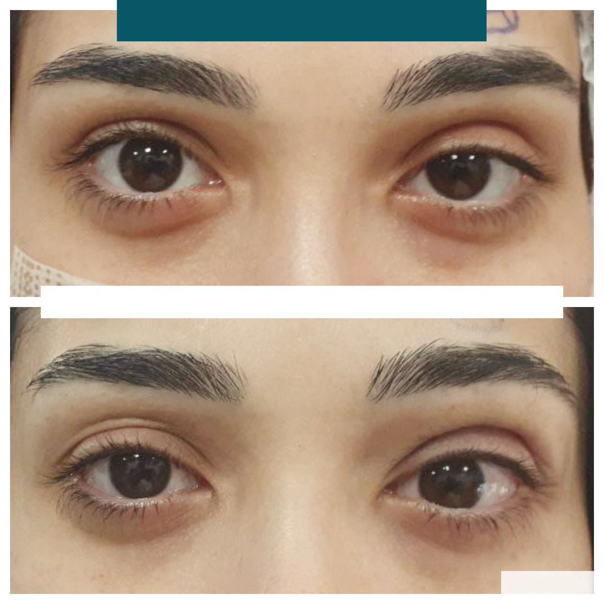 Before and after strabismus surgery result at DrCagatay Eye Clinic, improved eye alignment