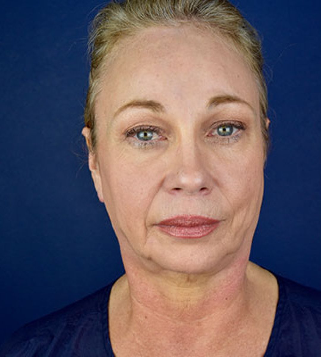 Resultado antes del lifting facial, flacidez y arrugas visibles antes del procedimiento