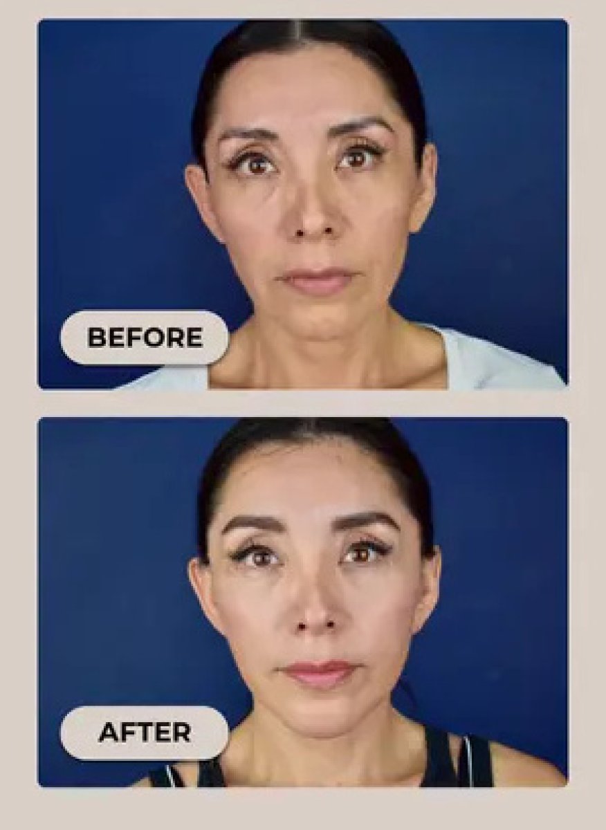 Facelift before and after results – visible facial rejuvenation and tighter skin effect