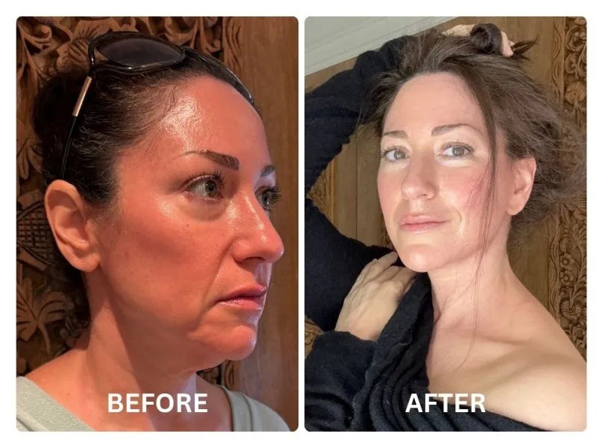 Resultados de lifting facial antes y después: rejuvenecimiento y piel más suave