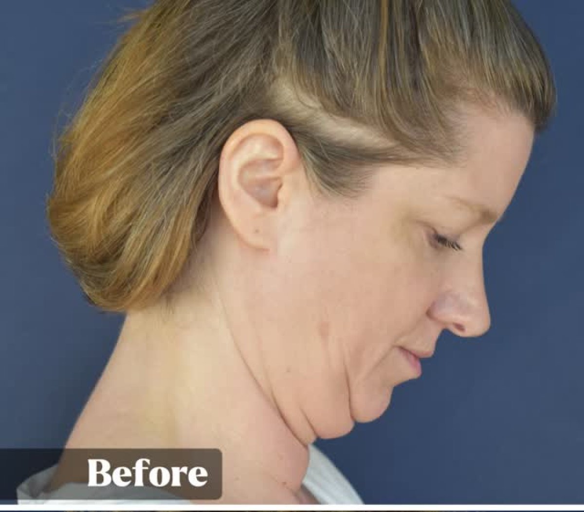 Antes de lifting de cuello, piel flácida y papada visible en paciente femenina