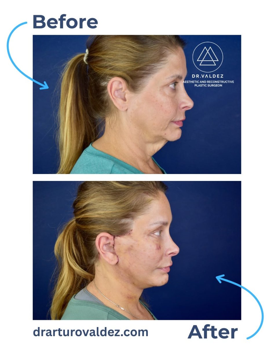 Before and after neck lift results at Dr. Valdez clinic – visible jawline and neck tightening