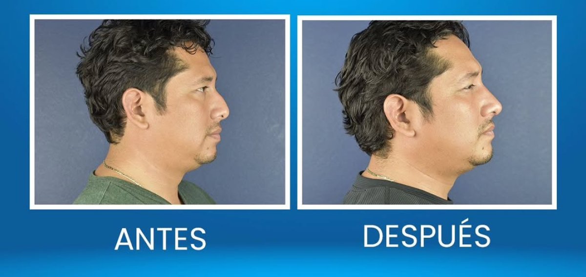 Before and after rhinoplasty results in male patient, improved nose profile and contour