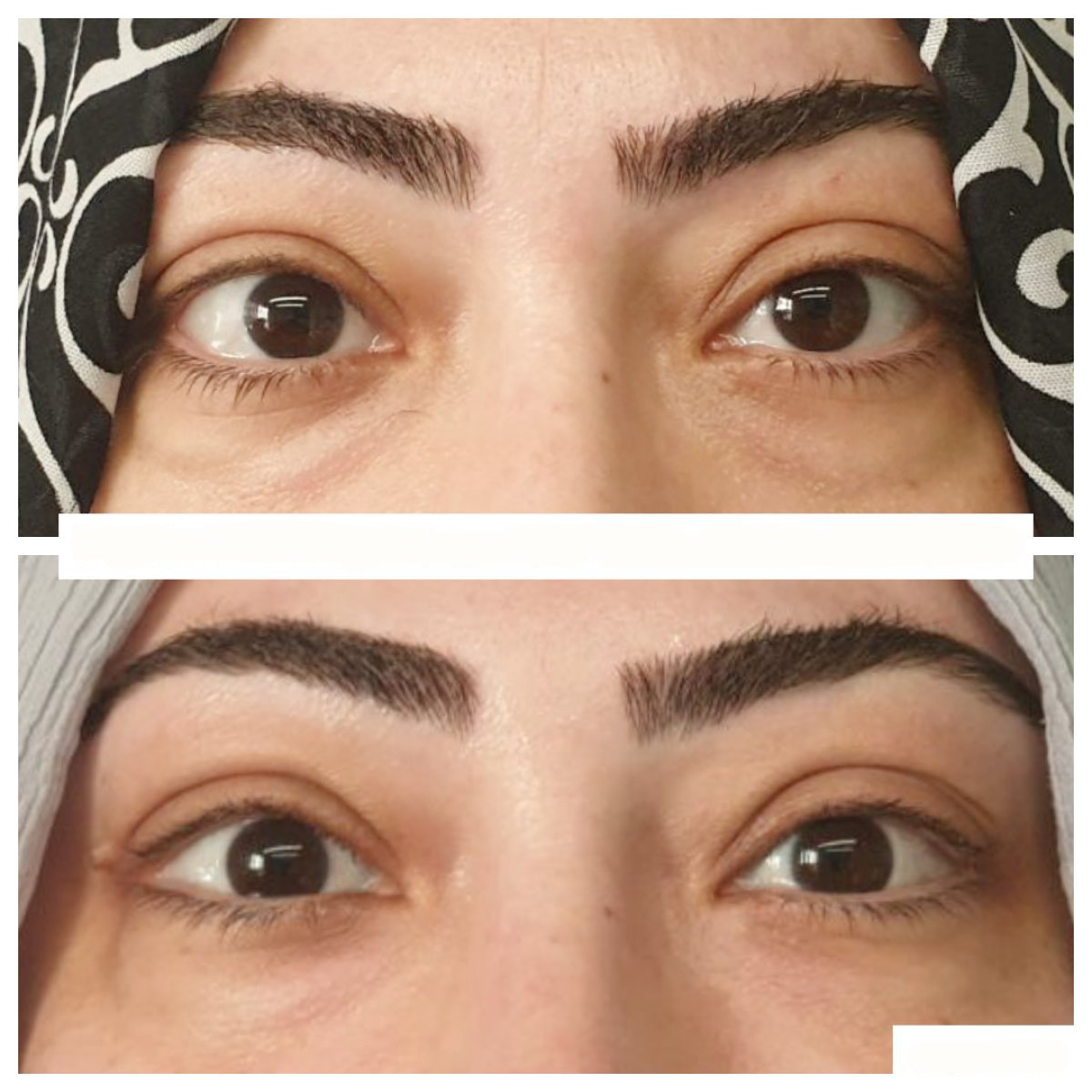Vorher-nachher-Ergebnis Schieloperation bei DrCagatay Eye Clinic, verbesserte Augenstellung