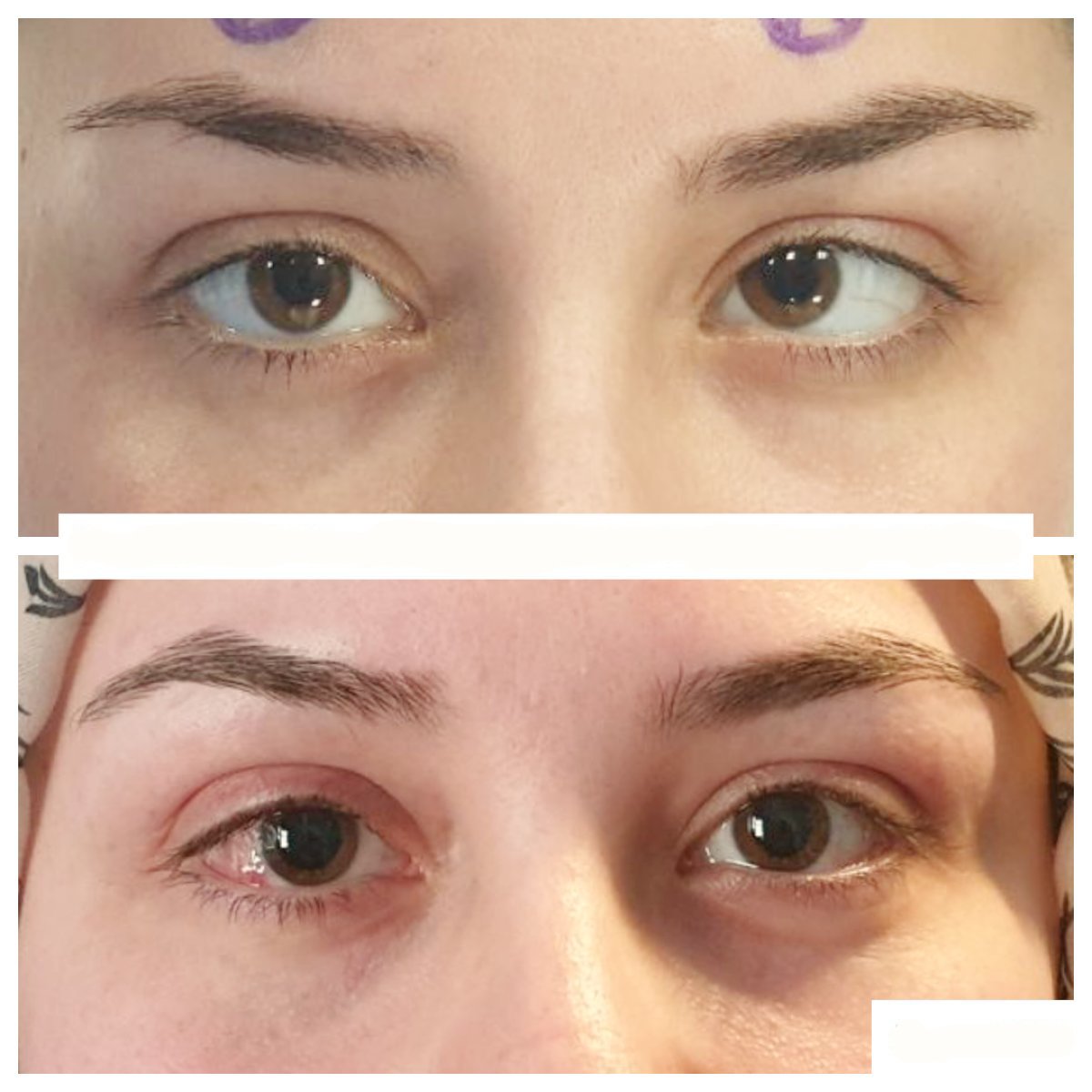 Résultats avant et après chirurgie du strabisme à DrCagatay Eye Clinic, alignement amélioré