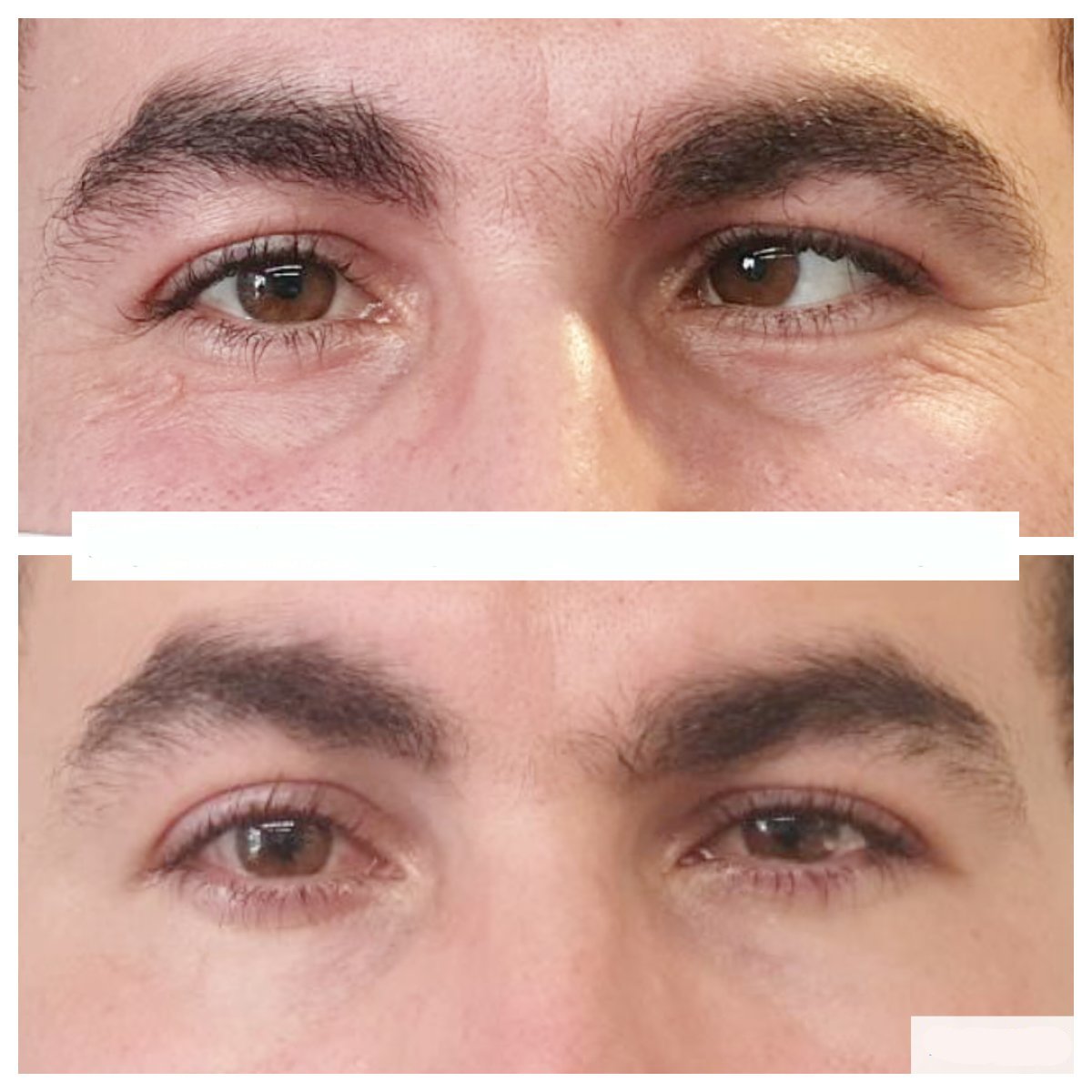 نتيجة قبل وبعد جراحة الحول في عيادة DrCagatay Eye Clinic، تحسين محاذاة العينين