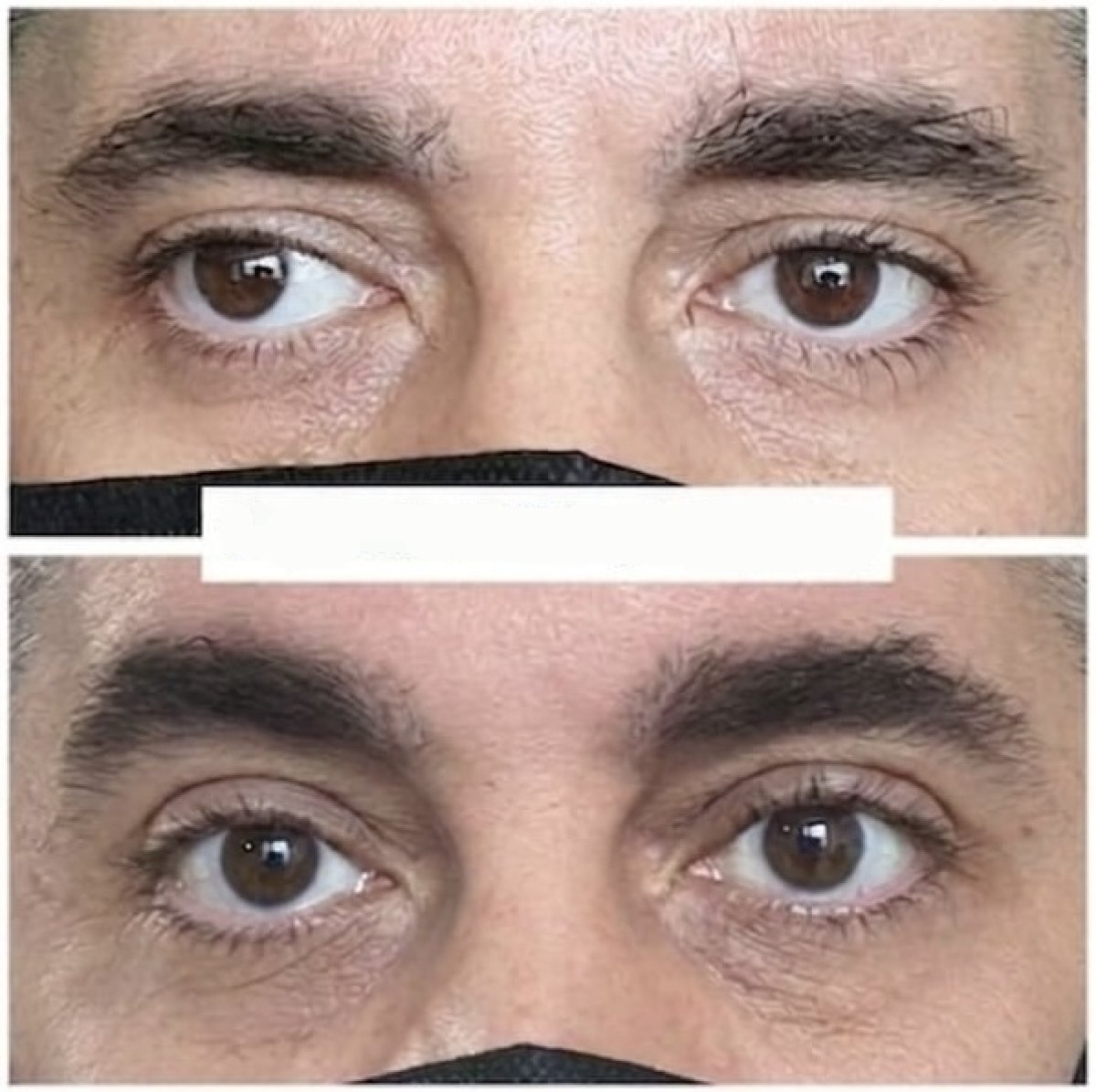 Результат до и после операции по косоглазию в DrCagatay Eye Clinic, выравнивание глаз