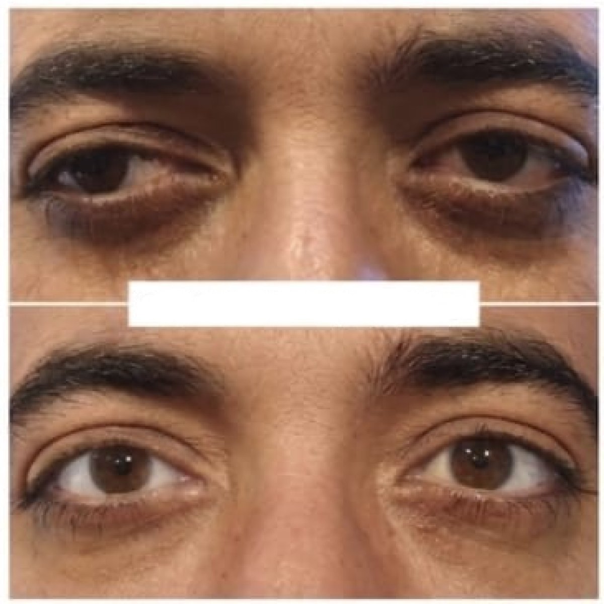 نتيجة قبل وبعد جراحة الحول في عيادة DrCagatay Eye Clinic، تصحيح محاذاة العين