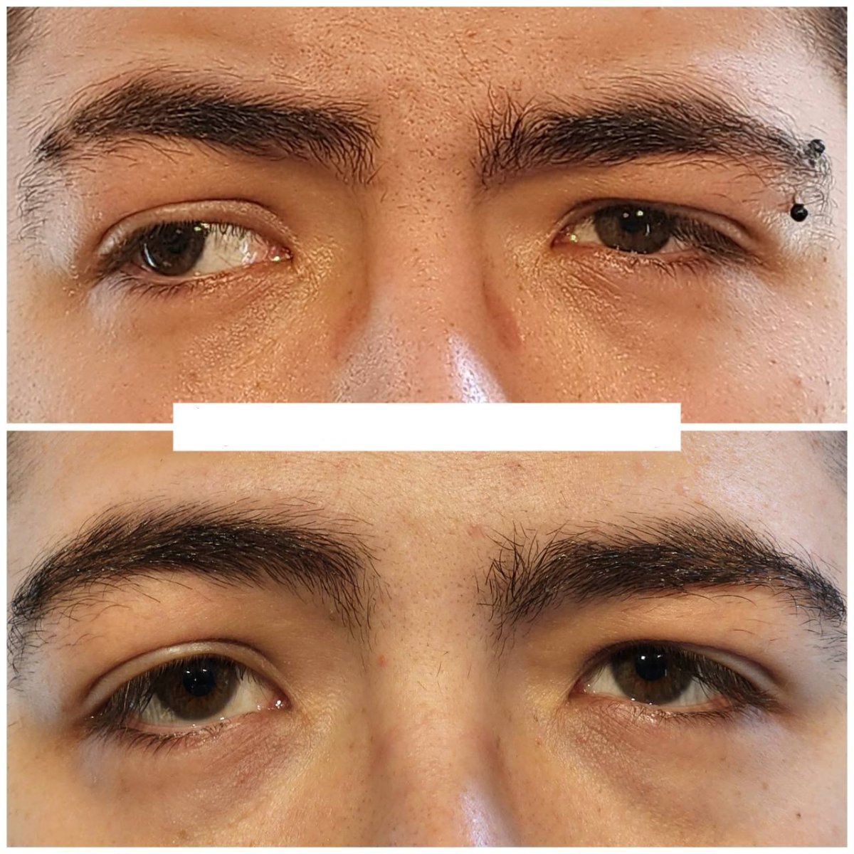 نتيجة قبل وبعد جراحة الحول في عيادة DrCagatay Eye Clinic، تصحيح محاذاة العين
