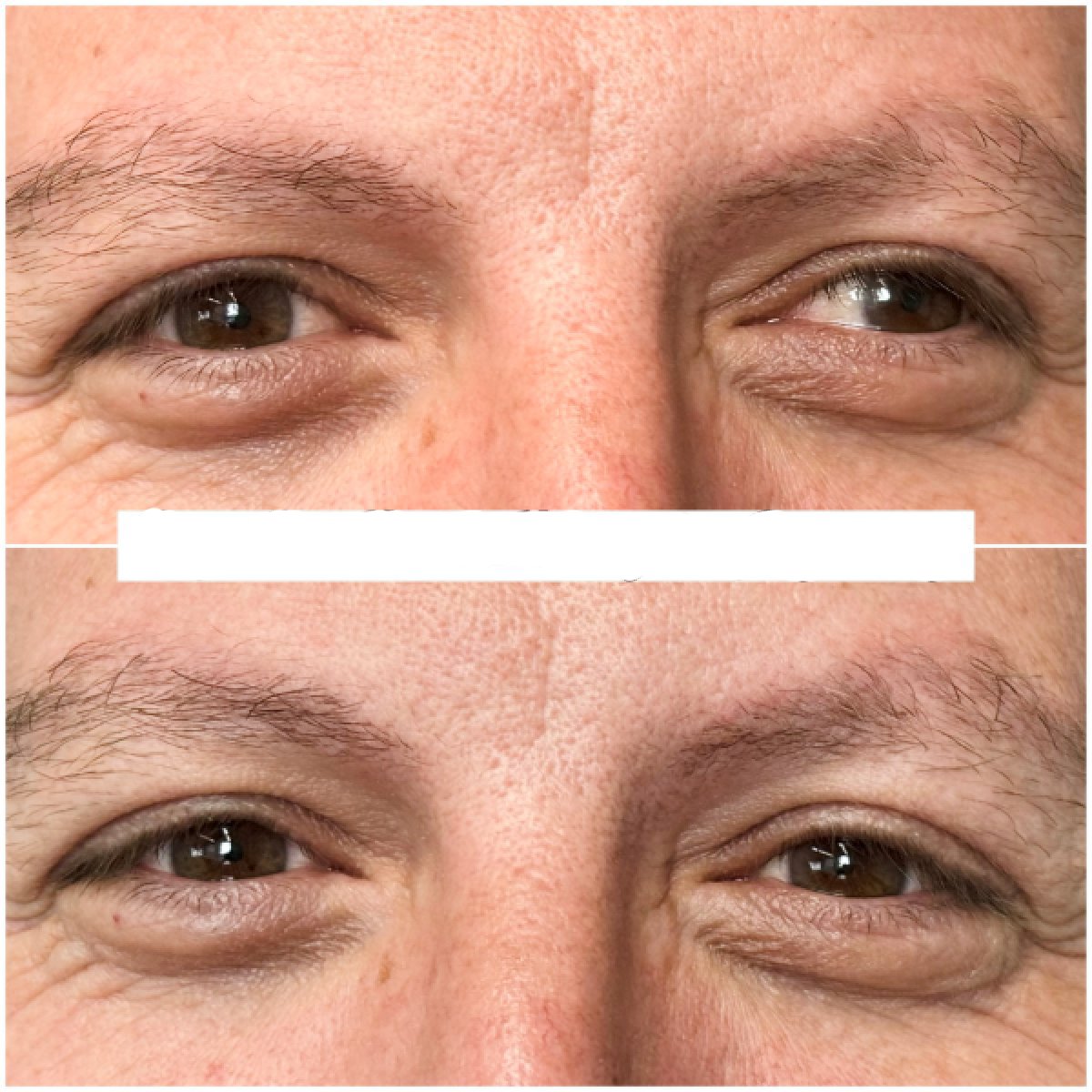 نتائج قبل وبعد جراحة الحول في عيادة DrCagatay Eye Clinic، تحسين محاذاة العينين