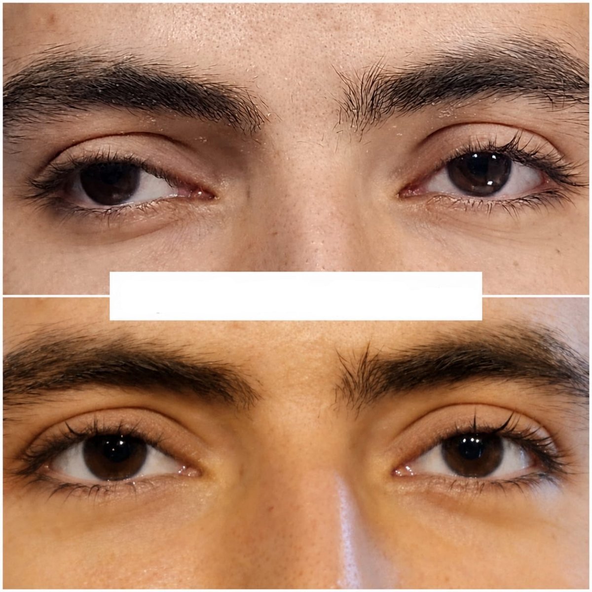 نتائج قبل وبعد جراحة الحول في عيادة DrCagatay Eye Clinic، تصحيح محاذاة العين