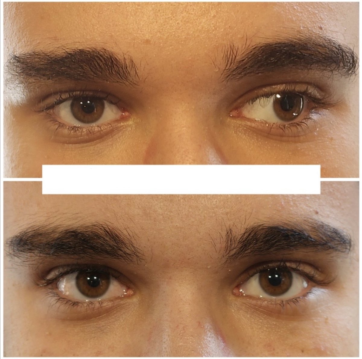 Before and after strabismus surgery result at DrCagatay Eye Clinic, improved eye alignment