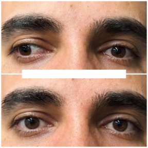 Standard Adult & Pediatric Strabismus Surgery Package - photo 5