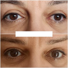 Standard Adult & Pediatric Strabismus Surgery Package - photo 6