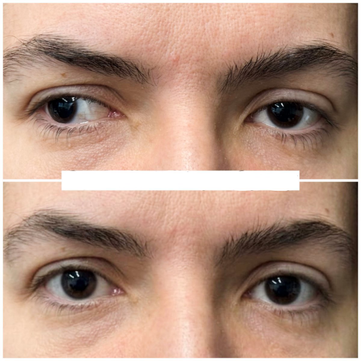 Efekty przed i po operacji zeza w DrCagatay Eye Clinic, poprawa ustawienia oczu