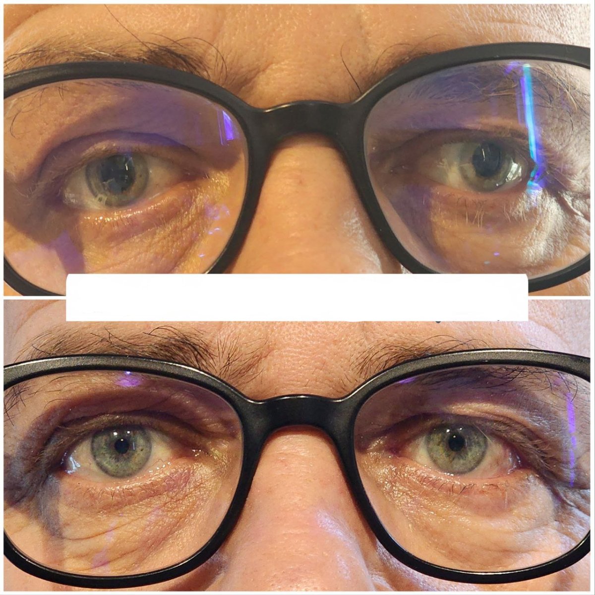 نتيجة قبل وبعد جراحة الحول في عيادة DrCagatay Eye Clinic، تحسين محاذاة العينين