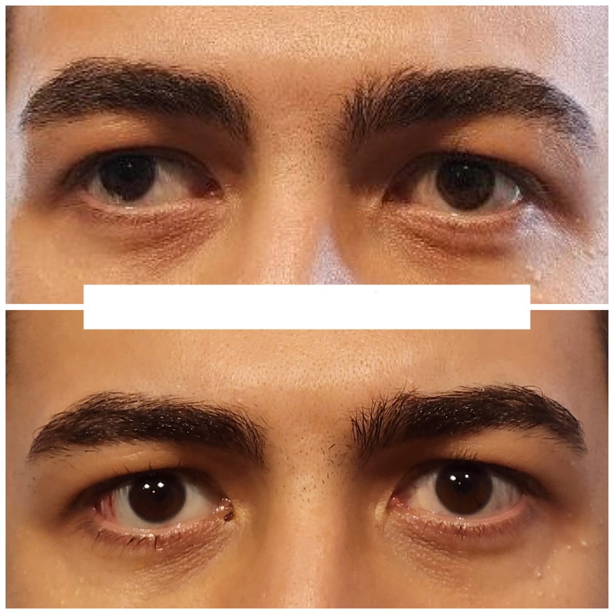 نتيجة قبل وبعد جراحة الحول في عيادة DrCagatay Eye Clinic، تحسين محاذاة العينين
