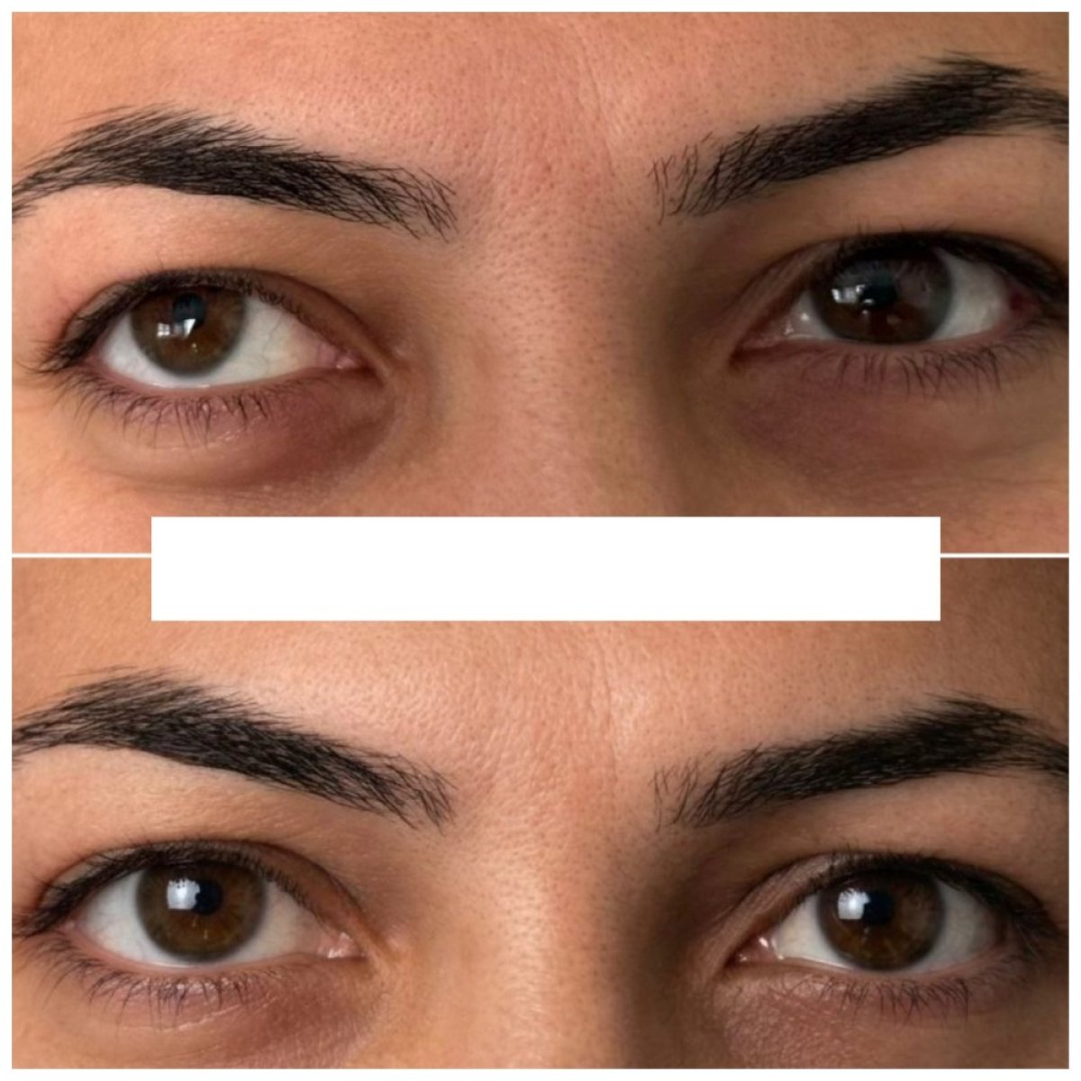 Before and after strabismus surgery result at DrCagatay Eye Clinic, improved eye alignment