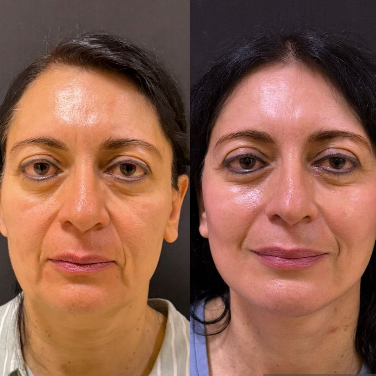 Résultats avant et après blépharoplastie chez Lucio Santos Plastic Surgery, correction des paupières