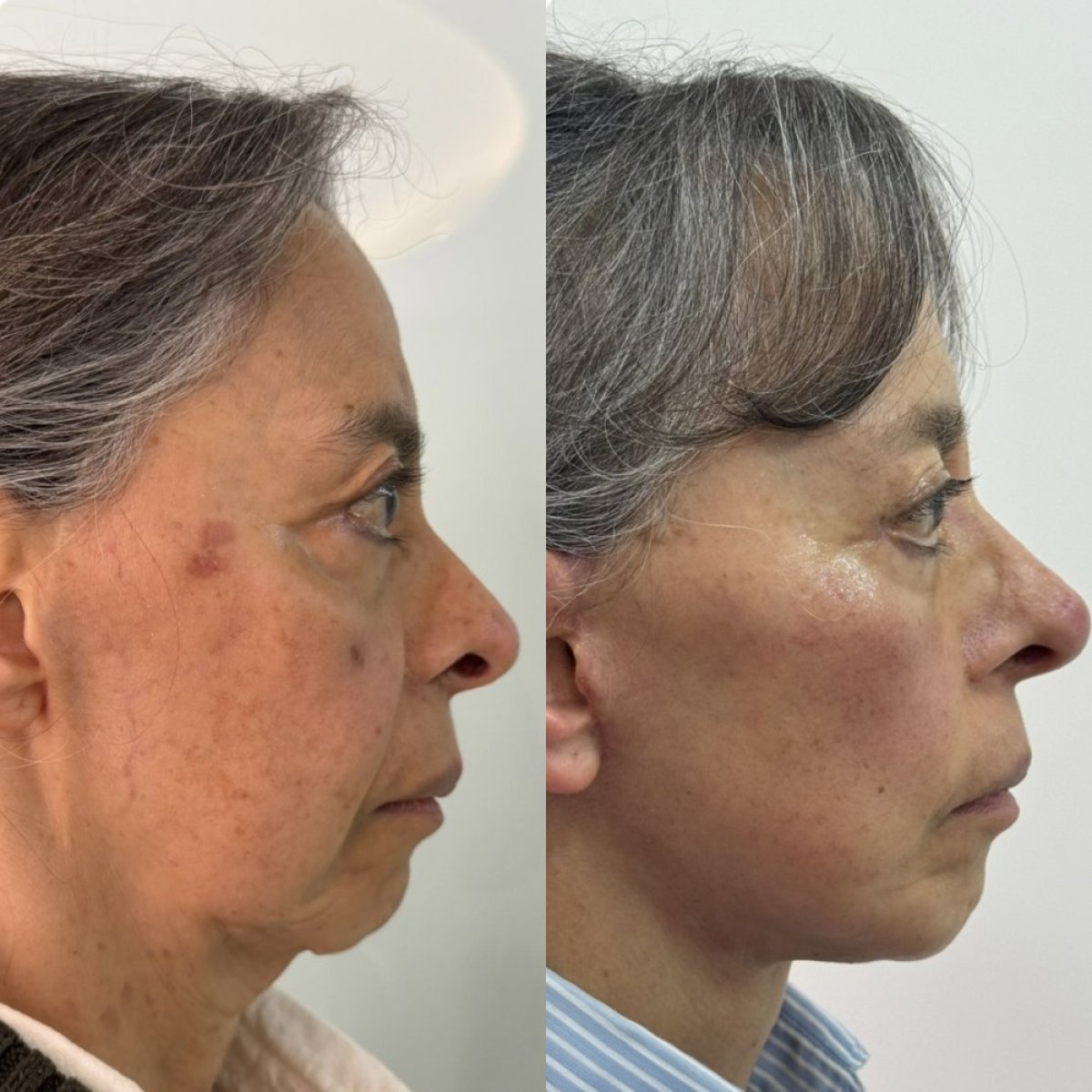 نتائج رأب الجفن قبل وبعد في Lucio Santos Plastic Surgery، تصحيح الجفون