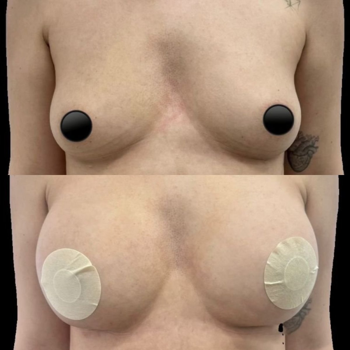 Résultats avant et après augmentation mammaire chez Lucio Santos Plastic Surgery, volume accru