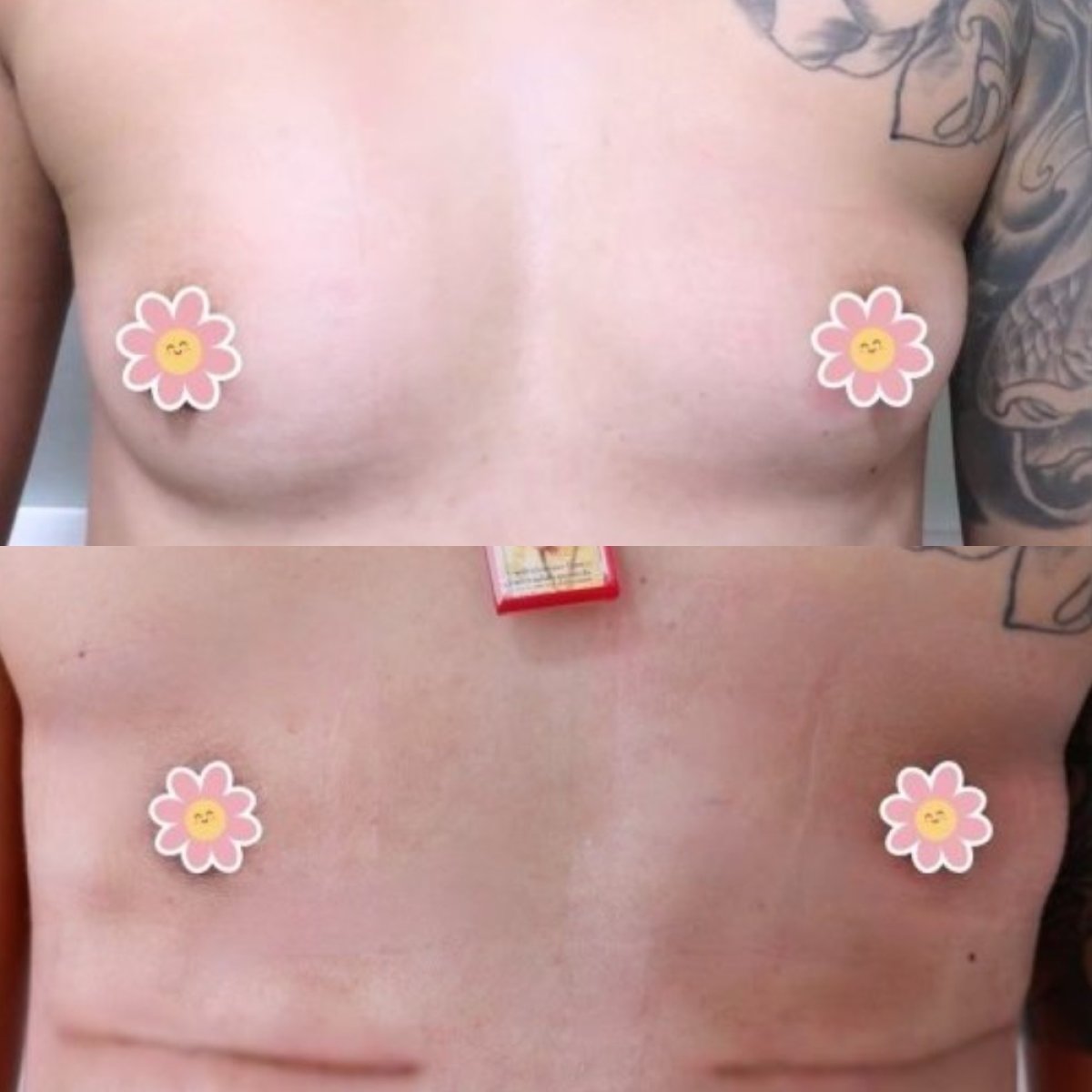 Résultats avant et après top surgery à la clinique Somchai, masculinisation du torse