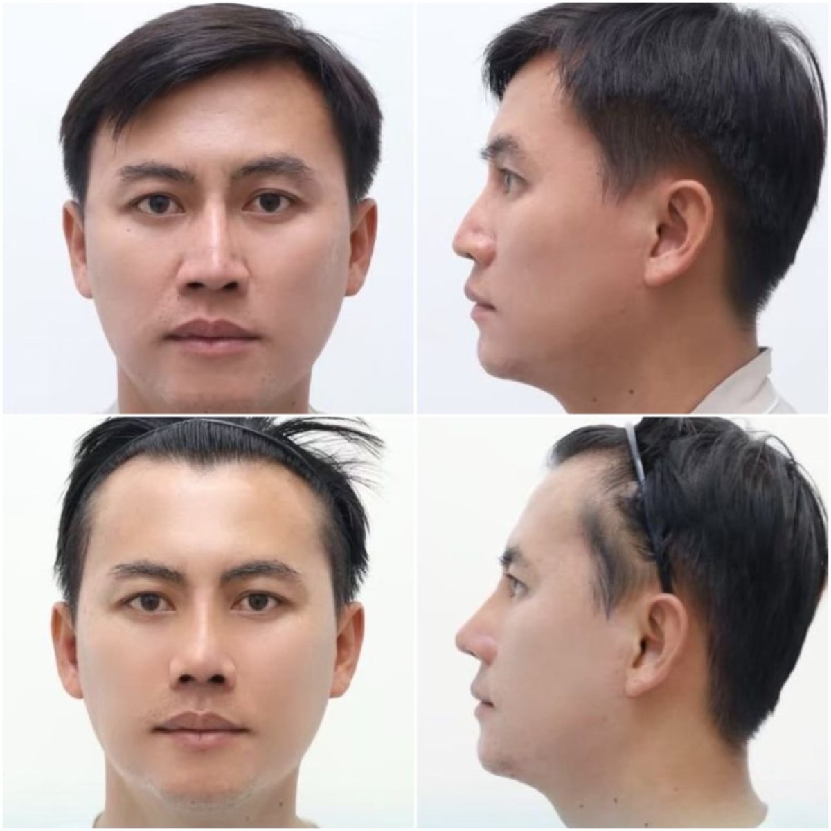 Résultats avant/après rhinoplastie à Wansiri Hospital, forme et profil du nez améliorés