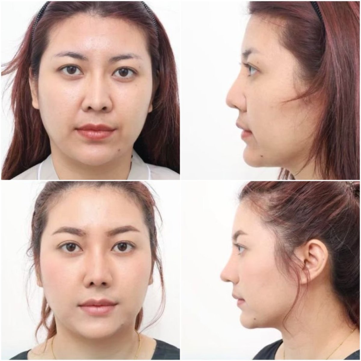 Efekty przed i po rhinoplastyce w Wansiri Hospital, naturalny wygląd nosa